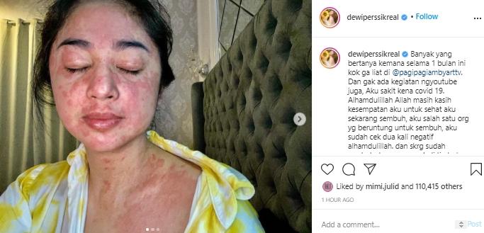 Dewi Perssik tunjukan badan penuh bercak merah (Instagram.com/dewiperssikreal)