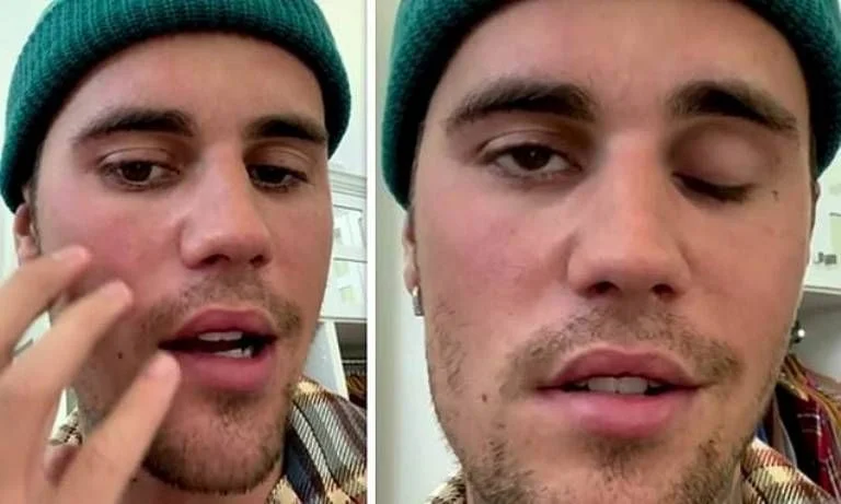 Justin Bieber Diserang Penyakit Langka Ramsay Hunt Syndrome, Kelumpuhan pada Wajah