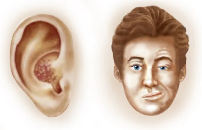 Apa Itu Ramsay Hunt Syndrome, Penyakit Langka yang Diderita oleh Justin Bieber