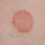 Mengenal Jamur Ringworm, Penyebab dan Apa Gejalanya