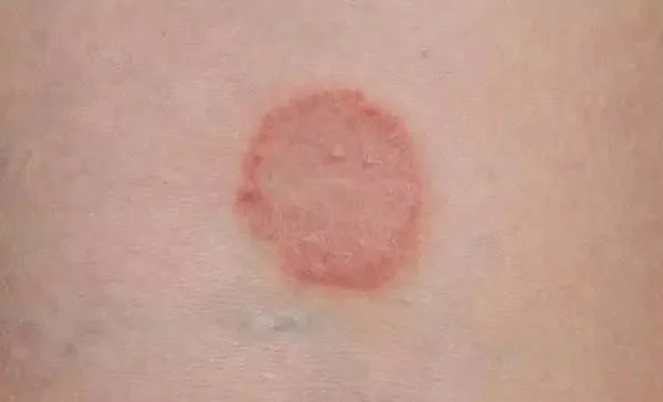 Mengenal Jamur Ringworm, Penyebab dan Apa Gejalanya